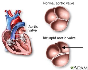 Illustration of a normal aortic valve and a bicuspid aortic valve with fusion of the left and right coronary cusps.