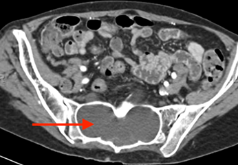 CT scan demonstrating lumbosacral dural ectasia