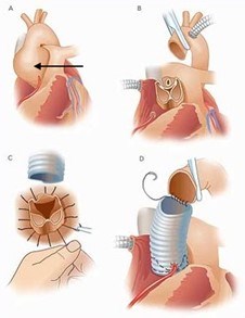 Illustration of the steps in a valve sparing root replacement procedure.
