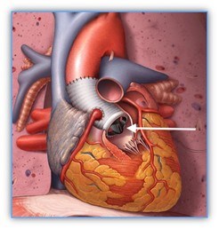 Illustration of a composite aortic valve and root replacement (Bentall procedure). A mechanical aortic valve prosthesis (show by an arrow) is at the proximal end of the graft and the coronary arteries are reattached to the graft.