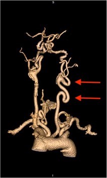 Image of a CT angiogram in a person with Loeys-Dietz syndrome demonstrating arterial tortuosity of the neck vessels.