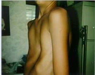 Photo of an individual with a sunken chest (pectus excavatum), a more common feature of Marfan syndrome.