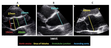Echocardiographic images of the aortic root and ascending aorta.