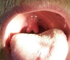 Photo inside an individual's mouth, showing a bifid uvula.