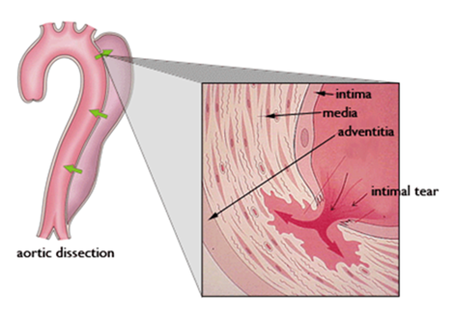 Three layers of the aortic wall - intima, media, adventitia