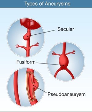 Illustrations of sacular-, fusiform-, and pseudoaneurysm-type aneurysms