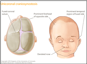 Top view of the head and front view of the face showing craniosynostosis in Loeys-Dietz syndrome