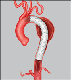Stent graft to treat aortic dissection or aneurysm