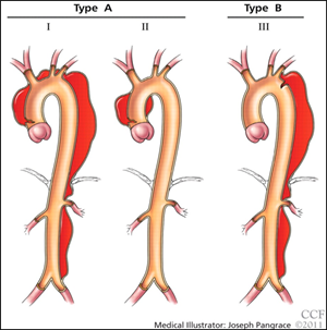 Type A and B classifications of aortic disease (Stanford classification) and Type I and II classifications of aortic disease (DeBakey classification)